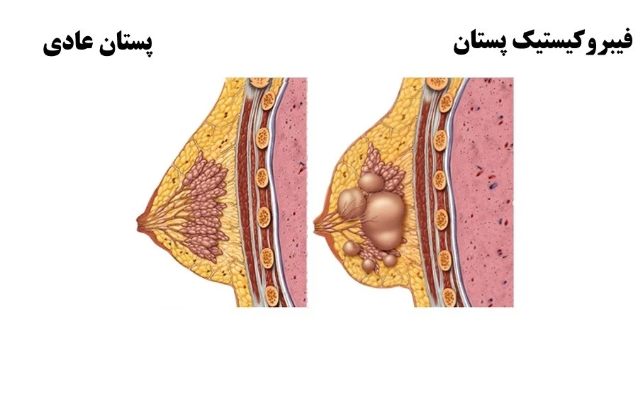 عکس تغییرات فیبروکیستیک پستان و پستان عادی