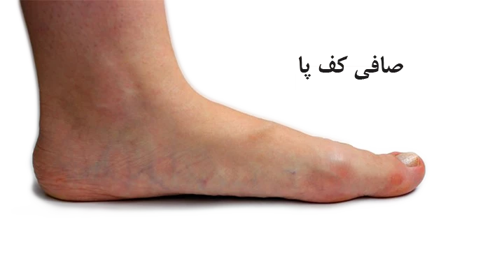 صافی کف پا چیست؟