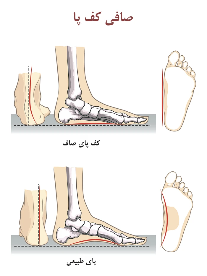 علل صافی کف پا
