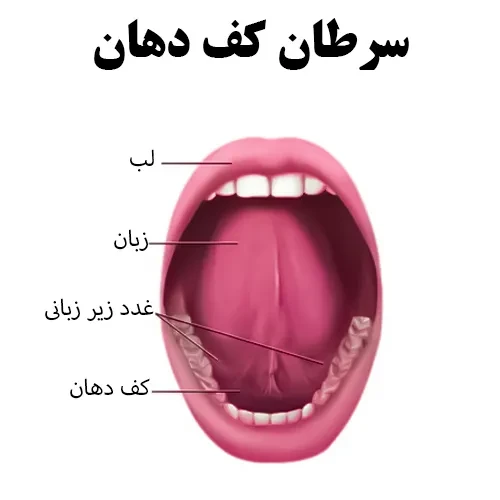 سرطان کف دهان