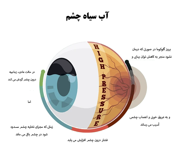 افزایش فشار داخل چشم از علل بیماری گلوکوما
