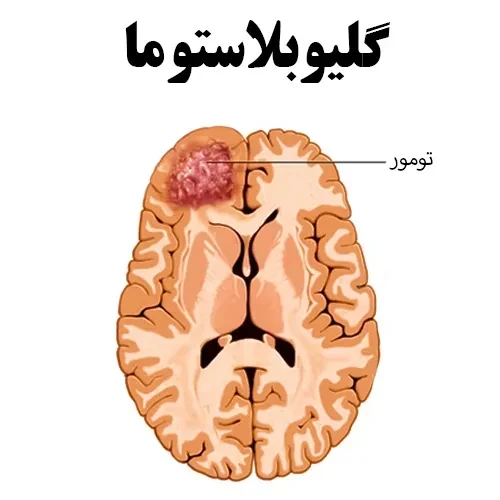 تومور مغزی گلیوبلاستوما