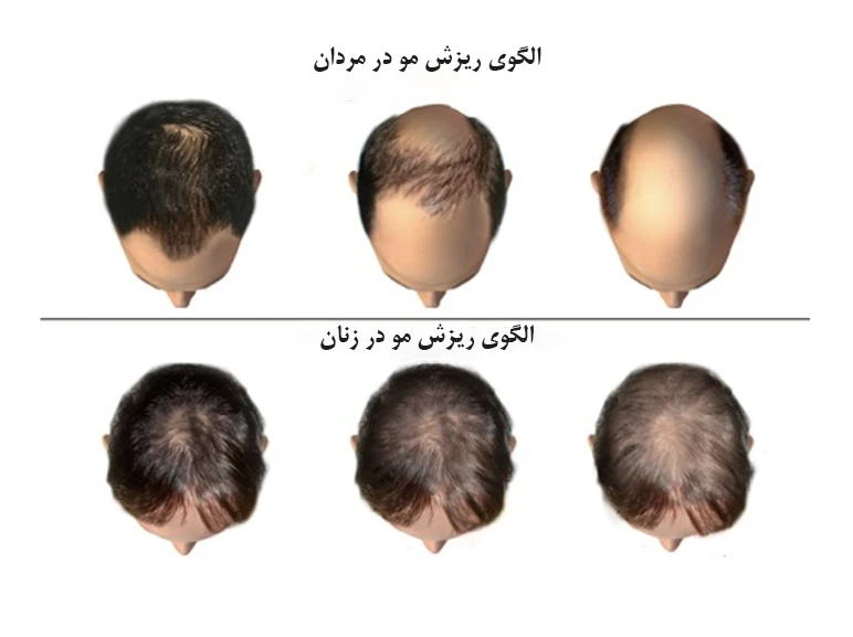 مراجعه به پزشک در صورت ریزش مو