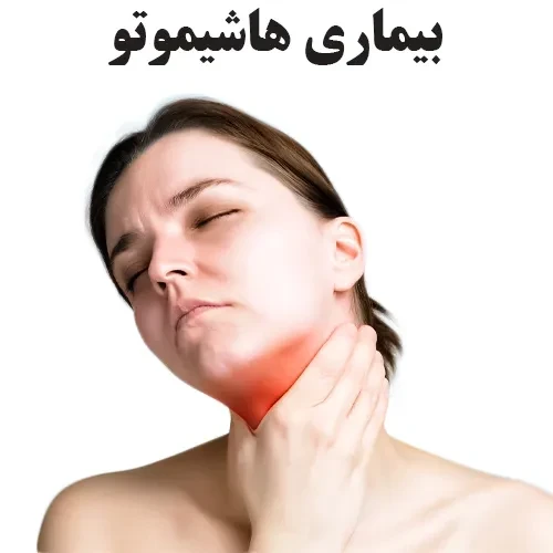 بیماری هاشیموتو چیست؟