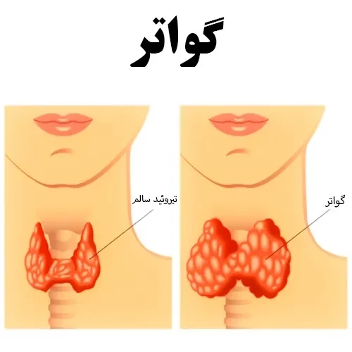 گواتر از عوارض ابتلا به بیماری هاشیموتو