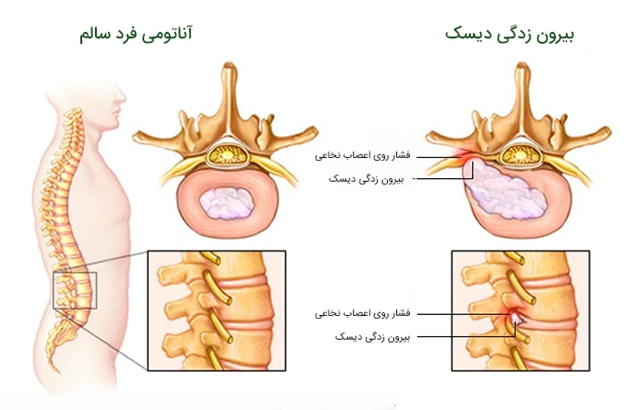 علائم دیسک کمر و گردن