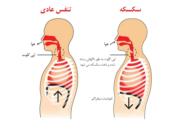 سکسکه ناشی از آسیب عصبی