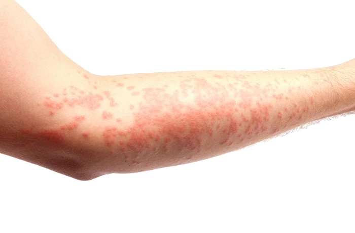 کهیر و آنژیوادم چیست؟