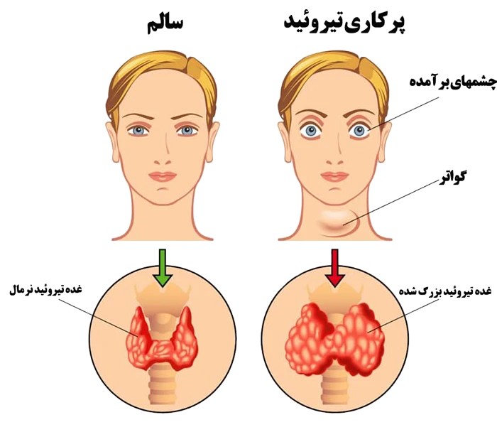 چشم های برآمده از نشانه های پرکاری تیروئید (هایپرتیروئیدیسم)