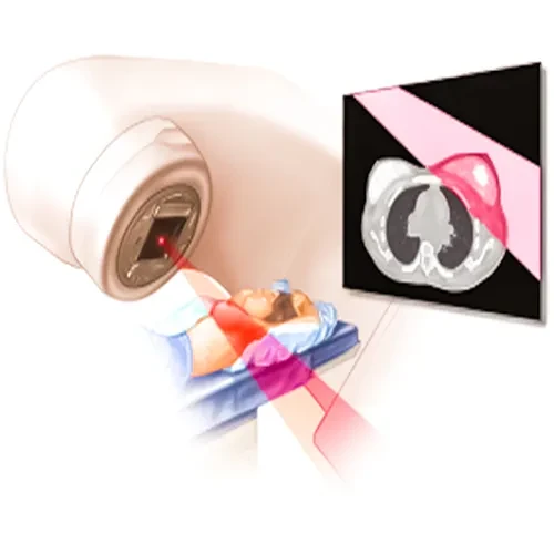 رادیوتراپی سرطان پستان