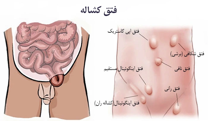 فتق کشاله ران (اینگوینال) چیست؟