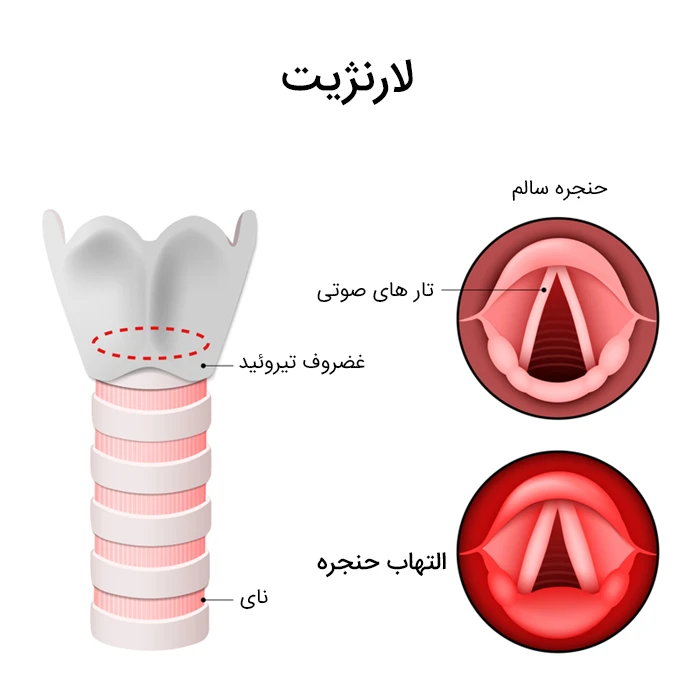 گلودرد از علائم التهاب حنجره (لارنژیت)