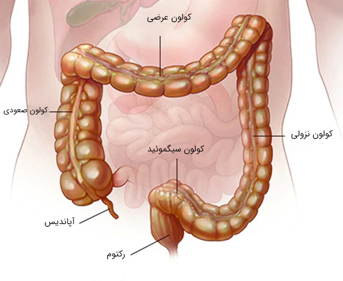 کولیت میکروسکوپی