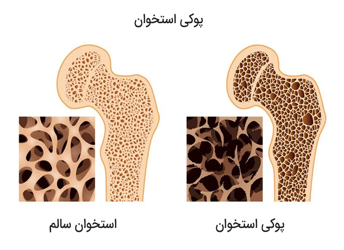 کاهش تراکم بافت استخوانی در بیماری پوکی استخوان
