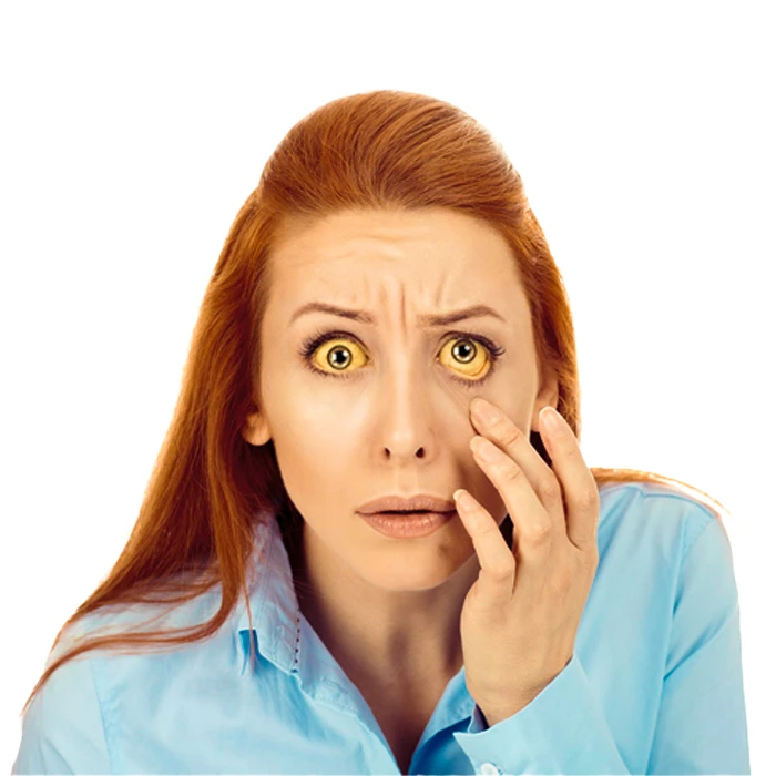 زرد شدن سفیدی چشم از عوارض سرطان پانکراس