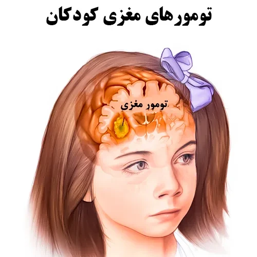 تومورهای مغزی کودکان