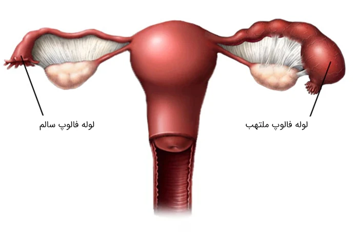 التهاب لوله فالوپ به دلیل بیماری التهابی لگن