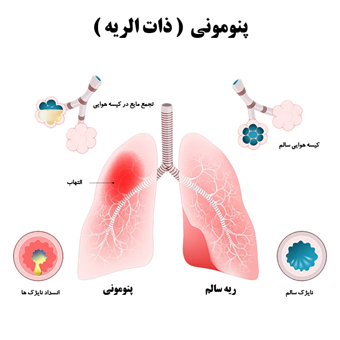 بیماری ذات الریه (پنومونی یا سینه پهلو)