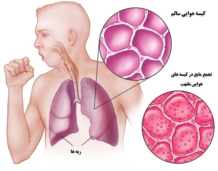 تجمع مایع در کیسه های هوایی از عوارض بیماری بیماری ذات الریه