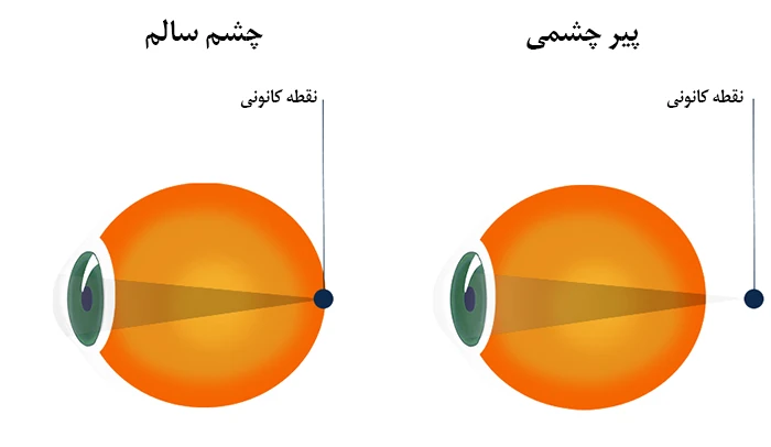 علل ابتلا به پیرچشمی
