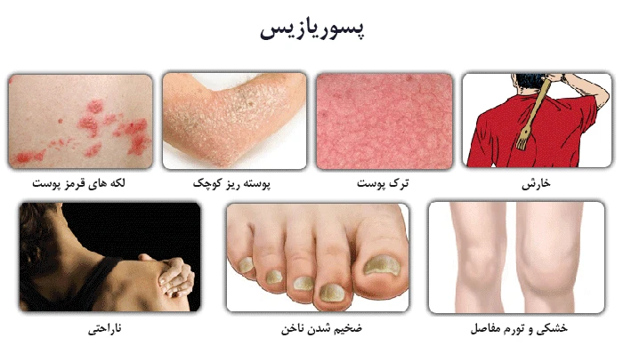 علادم مختلف پسوریازیس