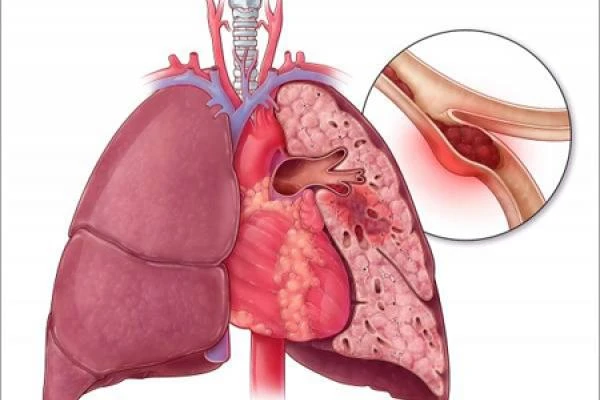 آمبولی ریوی در نتیجه انسداد توسط بخشی از تومور