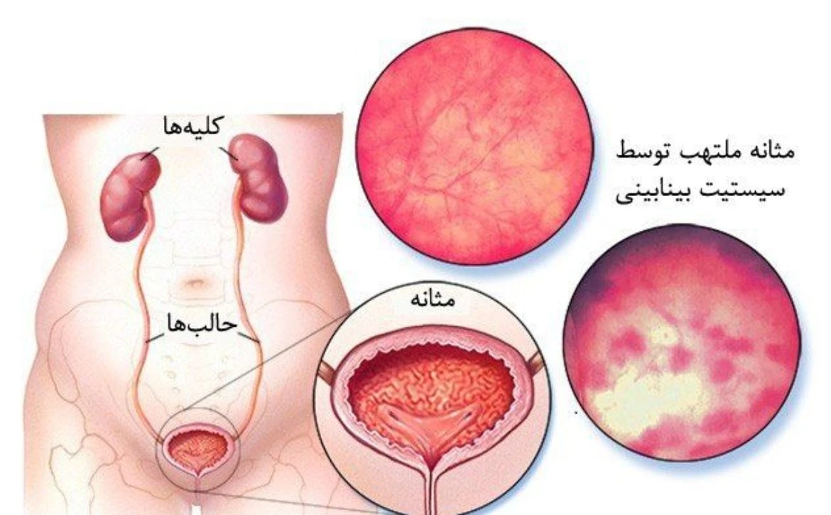 عوامل خطرساز ابتلا به عفونت کلیه (پیلونفریت)