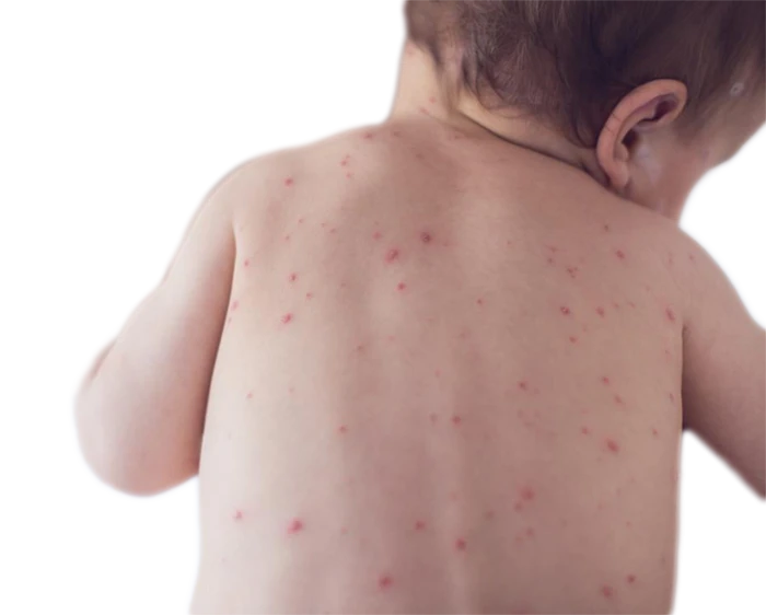 سرخجه (سرخک آلمانی) چیست؟