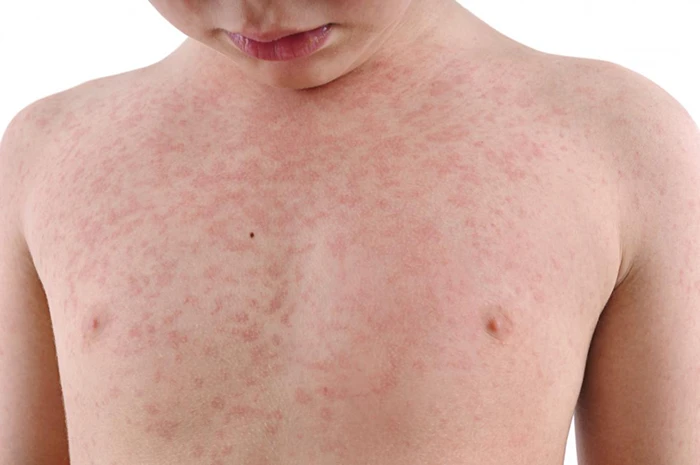 ابتلا به سرخجه (سرخک آلمانی) از طریق تماس مستقیم با بیمار
