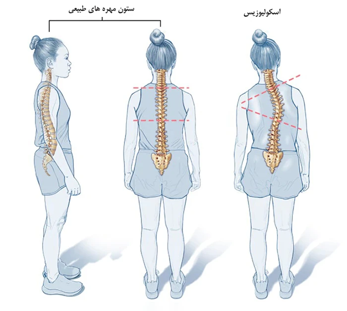 اسکولیوز یا انحنای جانبی ستون فقرات چیست؟
