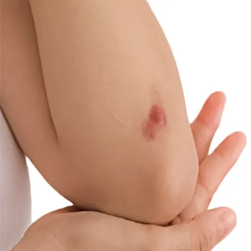 بروز زخم های فلس مانند روی پوست از علائم سرطان سلول های سنگفرشی