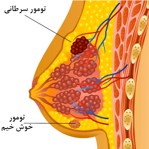 توده های پستانی خوش خیم و بدخیم (سرطانی)