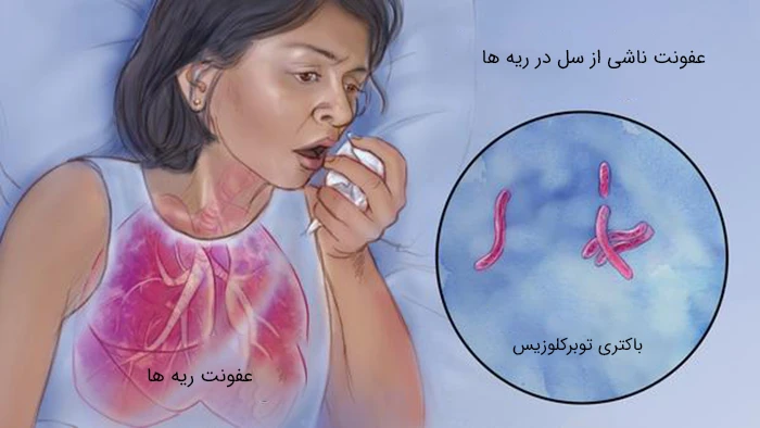 ورود باکتری سل از طریق هوا به ریه از علل ابتلا به بیماری سل