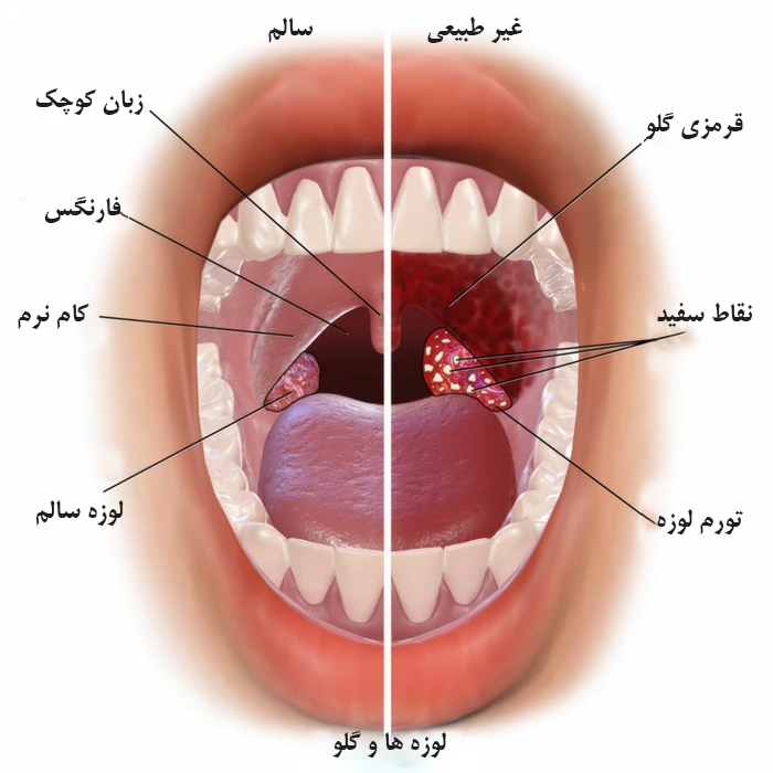 انواع سرطان گلو