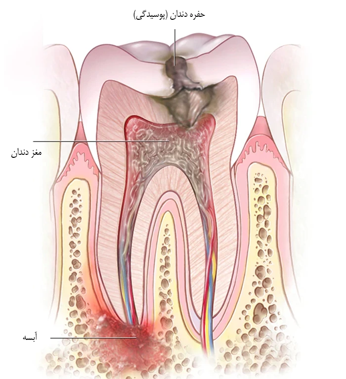 ورود آبسه به مغز دندانی از علل ابتلا به آبسه دندان