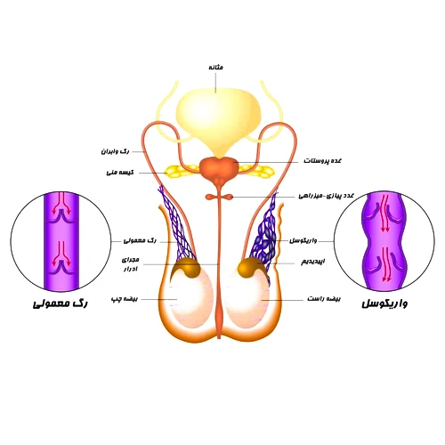 علل ابتلا به واریکوسل