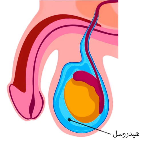 تجمع مایع در اطراف بیضه ها در نتیجه درمان واریکوسل