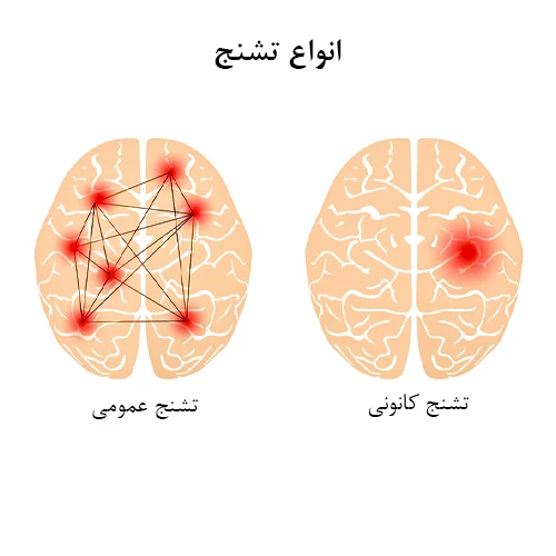 درمان تشنج کانونی با مصرف داروی اسلی کاربازپین