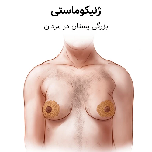 ژنیکوماستی (افزایش حجم بافت سینه در پسران یا مردان)