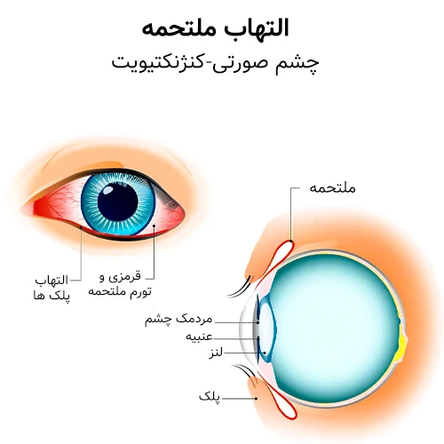 التهاب ملتحمه (کنژنکتیویت یا بیماری چشم صورتی)