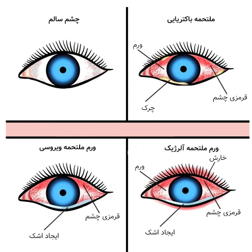 انواع التهاب ملتحمه چشمی