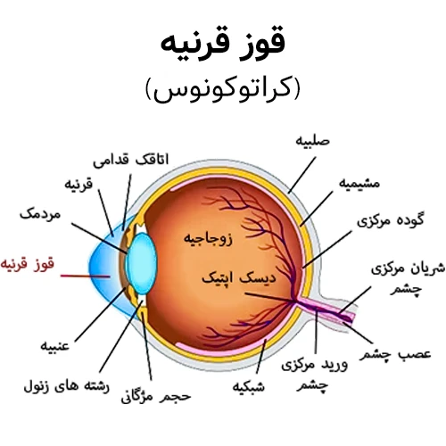 قوز قرنیه (کراتوکونوس)