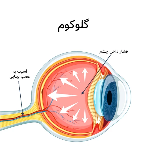 درمان فشار زیاد چشم ناشی از گلوکوم با قطره چشمی تیمولول