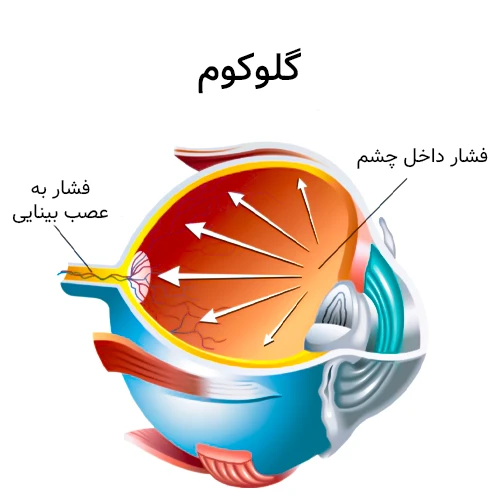 کاهش فشار داخل چشم در نتیجه گلوکوم با داروی لووبونولول چشمی