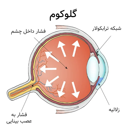 کاهش فشار داخل چشم با قطره چشمی پیلوکارپین