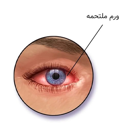 درمان ورم ملتحمه با مصرف قطره چشمی گاتی فلوکساسین