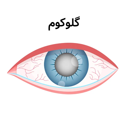 درمان گلوکوم با زاویه باز با مصرف قطره چشمی بریمونیدین