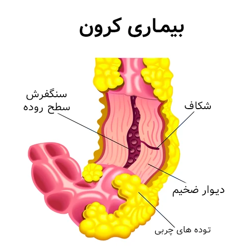 کنترل بیماری کرون با داروی ناتالیزوماب