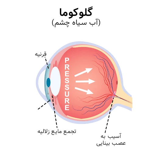 بیماری گلوکوما (آب سیاه چشم)