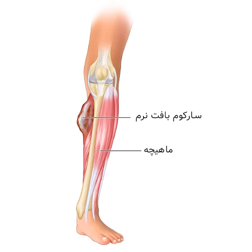 سارکوم بافت نرم